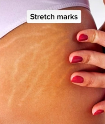 Bio-Oil : Scars, Stretch marks, Aging an